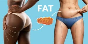 Is-BBL-and-Fat-Transfer-the-Same-