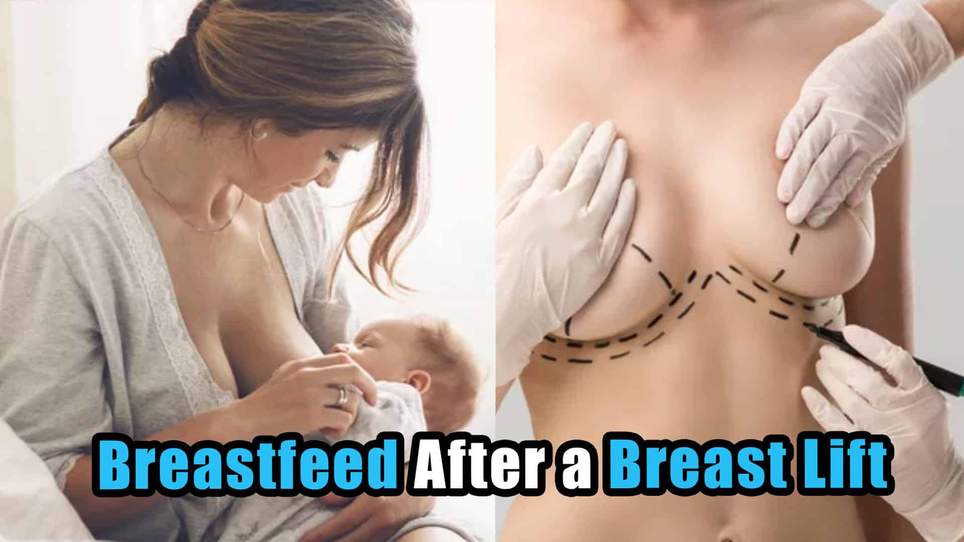 Can I Breastfeed After a Breast Lift Procedure? Tips for Recovery and Post-Operative Care