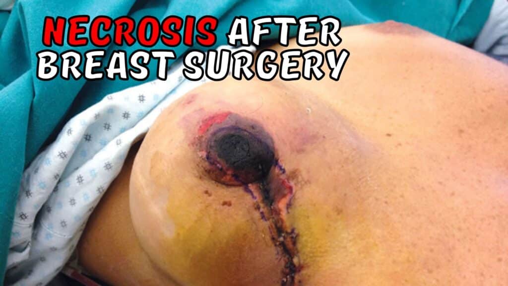 Fat Necrosis After Breast surgery