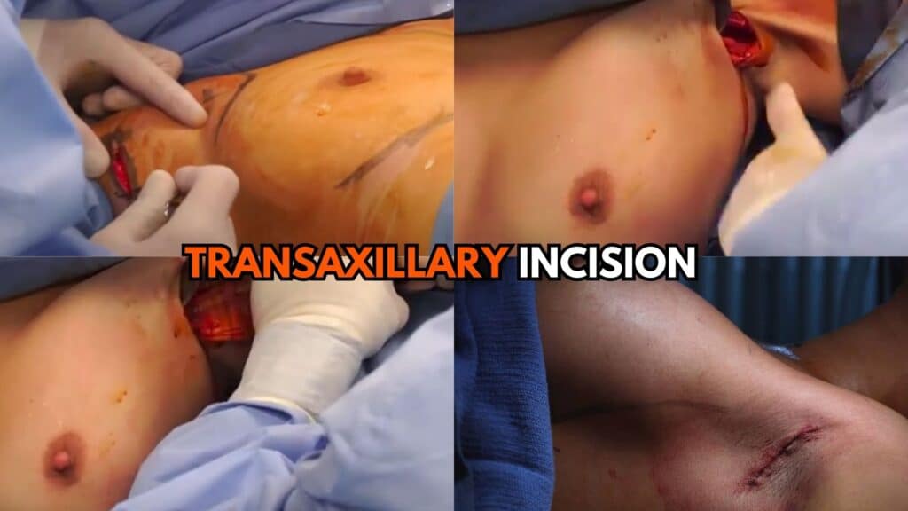 Transaxillary Incision Placement