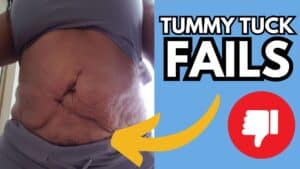 Tummy Tuck gone wrong- 9 things you should know!