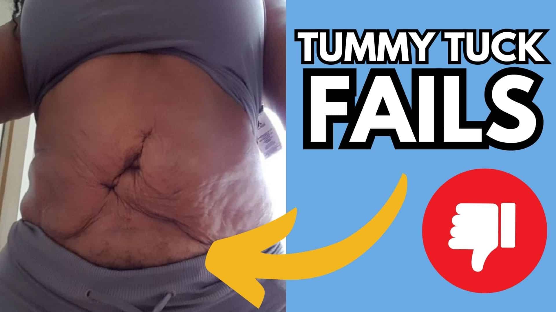 Tummy Tuck gone wrong- 9 things you should know!
