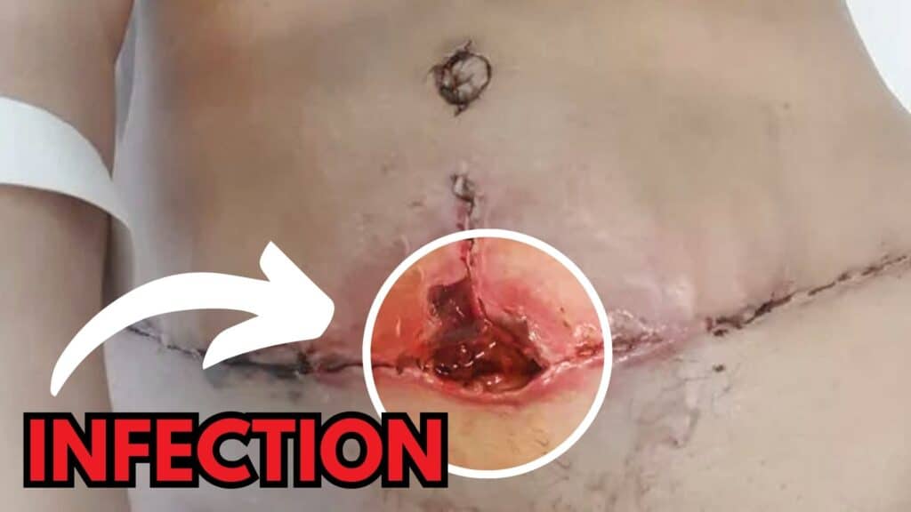 What are the common causes of Tummy Tuck gone wrong?